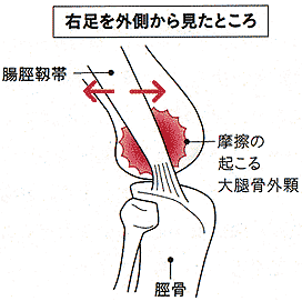 腸脛靭帯炎の発生 Phot by https://tiryo.net/tyoukeijintaien.html