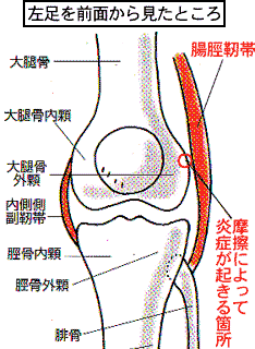 腸脛靭帯 Phot by https://tiryo.net/tyoukeijintaien.html